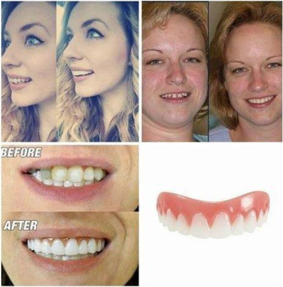 Instant Smile Veneers