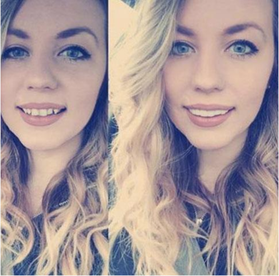 Instant Smile Veneers